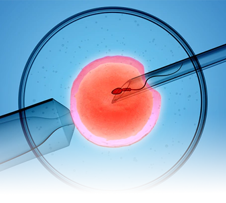 Intracytoplasmic Sperm Injection